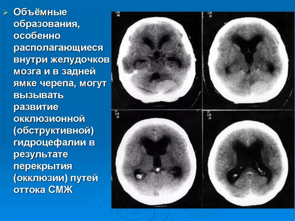 Образования желудочков мозга