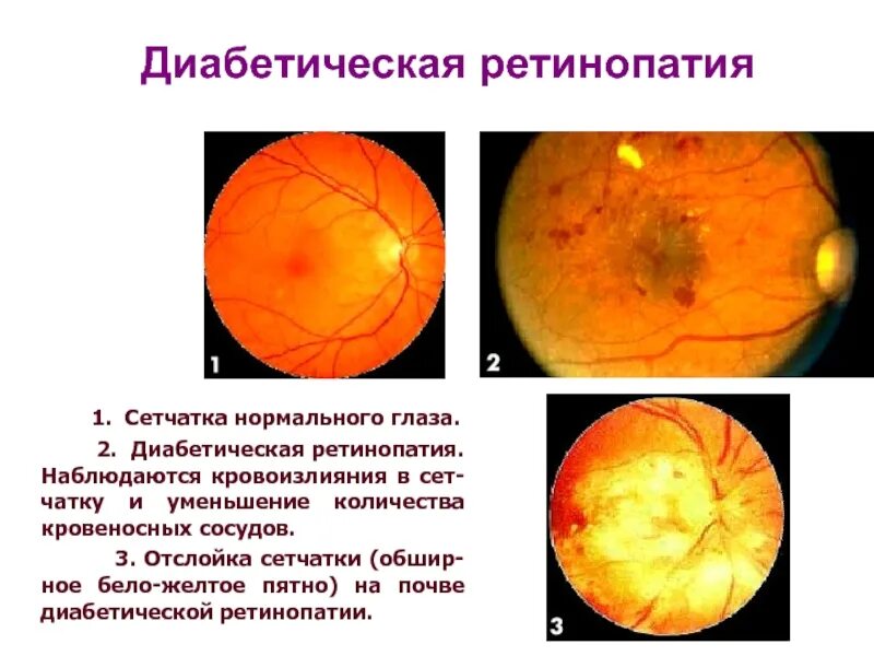 Диабетическая ретинопатия глазное дно. Пролиферативная диабетическая ретинопатия. Ангиопатия и ретинопатия сетчатки. Пролиферативная диабетическая ретинопатия глазное дно. Тест сетчатки глаза
