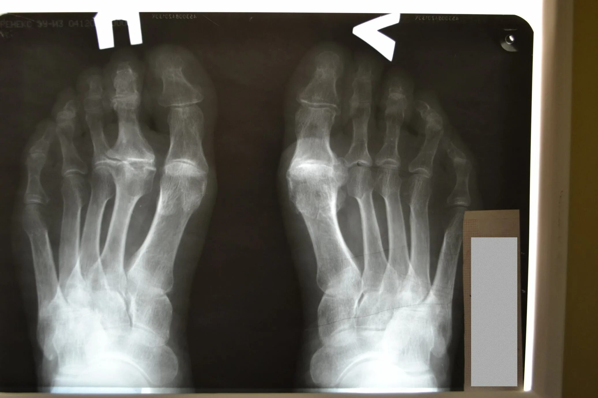 Остеохондропатия сесамовидной кости. Асептический некроз стопы. Асептический некроз таранной кости мрт. Остеохондропатия фрейберга-келера ii. Некроз ладьевидной кости стопы.