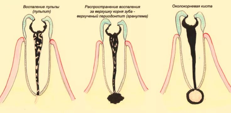 Воспаление леченого корня зуба. Восполениеикорня зуба. Воспаление накорне Зума.