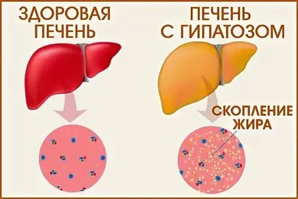 Увеличение печени это. Гепатомегалия при гепатите. Гепатомегалия жировой гепатоз. Гепатомегалии печени что это такое.