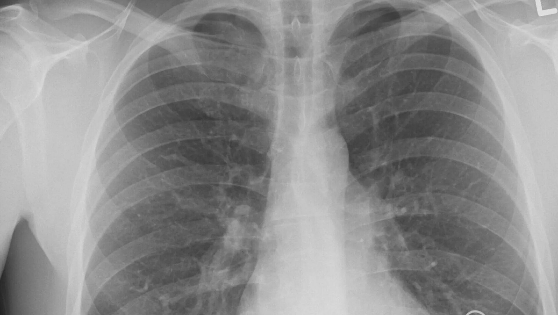 Коронавирусная пневмония на рентгене. Снимки легких. Снимок лёгких. Рентген лёгких. Поражением легких 50