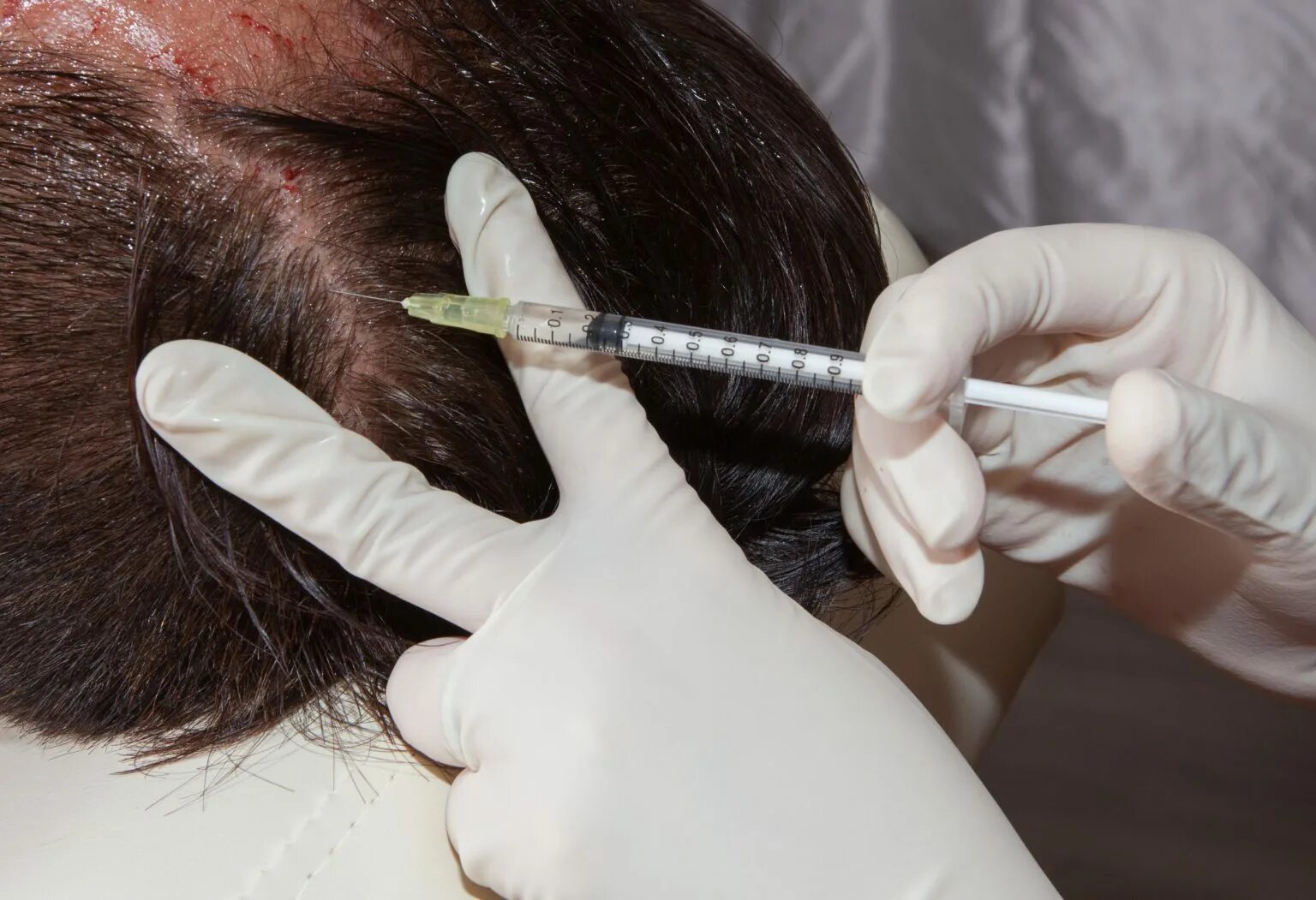 Инъекции головы. Мезотерапия для волос. Мезотерапия волосистой части головы. Уколы для волос. Уколы в голову для роста волос.