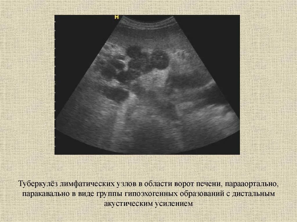 Мезентериальные лимфатические узлы в брюшной полости УЗИ. Парааортальные лимфатические узлы на УЗИ. Лимфаденопатия ворот печени УЗИ. УЗИ лимфатических узлов брюшной полости.