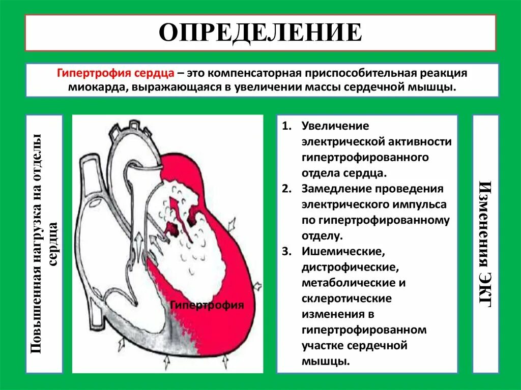 Гипертрофия левых отделов. Повышение электрической активности миокарда. Гипертрофия миокарда сердца. Повышение активности левого желудочка. Желудочка сердца расширена