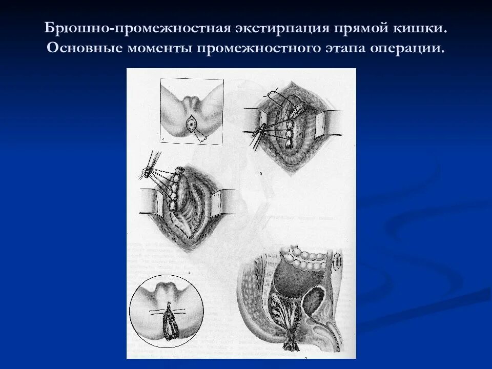 Брюшно-промежностная экстирпация прямой кишки операция кеню-майлса. Брюшно-промежностная экстирпация прямой кишки по кеню майлсу. Брюшно-промежностная экстирпация прямой кишки этапы. Брюшно-промежностная экстирпация (операция кеню-майлса). Операция брюшно-промежностная экстирпация.