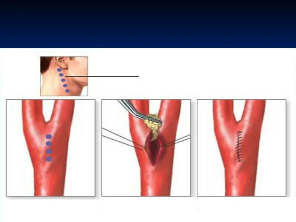 Бляшка на шее операция. Каротидная эндартерэктомия. Каротидная эндартерэктомия классификация. Операция каротидная эндартерэктомия. Каротидная эндартерэктомия сонной артерии.