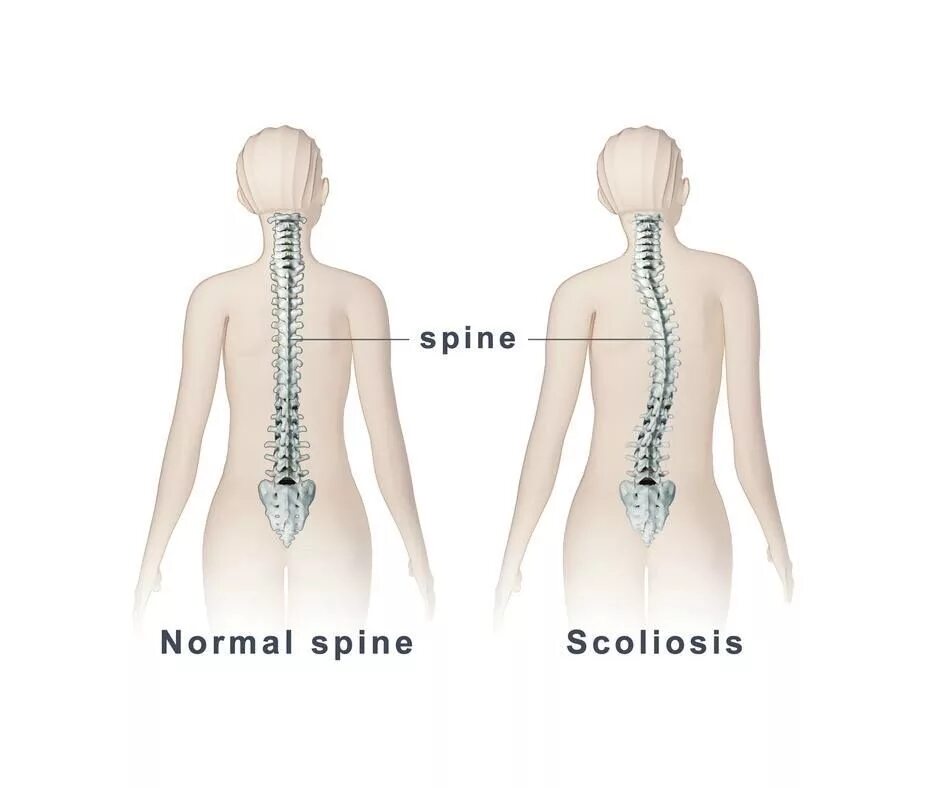 Прямо спинного. Деформация позвоночника, сколиоз. Сколиотическая деформация позвоночника. Сколиоз позвоночника скелет. S образная сколиотическая деформация позвоночника.