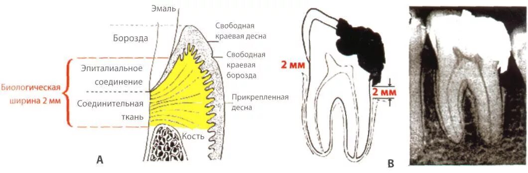 Биологическая ширина в стоматологии. Зона биологической ширины стоматология. Биологическая ширина зуба. Биологическое пространство зуба.