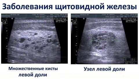 Кистозно солидное образование левой доли
