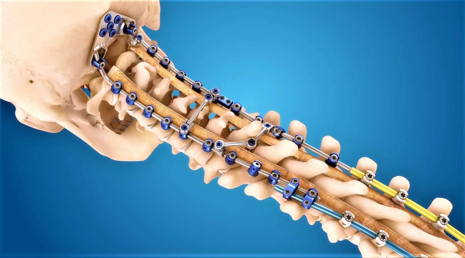 Вентральный спондилодез. Передний шейный спондилодез. Дорсальный спондилодез. Спондилодез кейджем. Спондилодез кейджем.