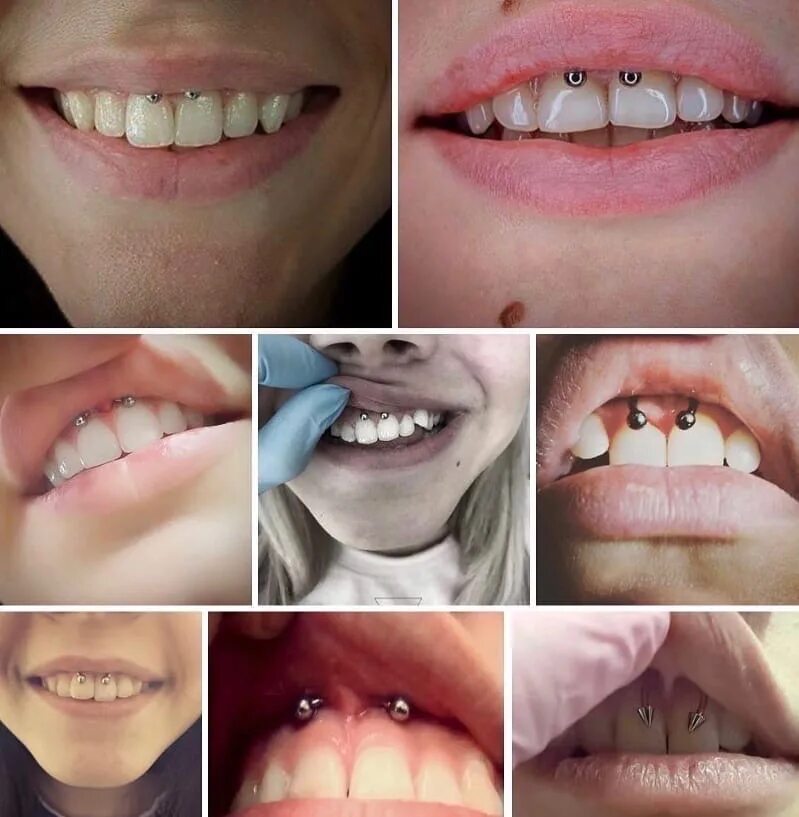 Прокол уздечки нижней губы. Заживший смайл. Пирсинг уздечки верхней. Пирсинг уздечки верхней губы. Заживший смайл.