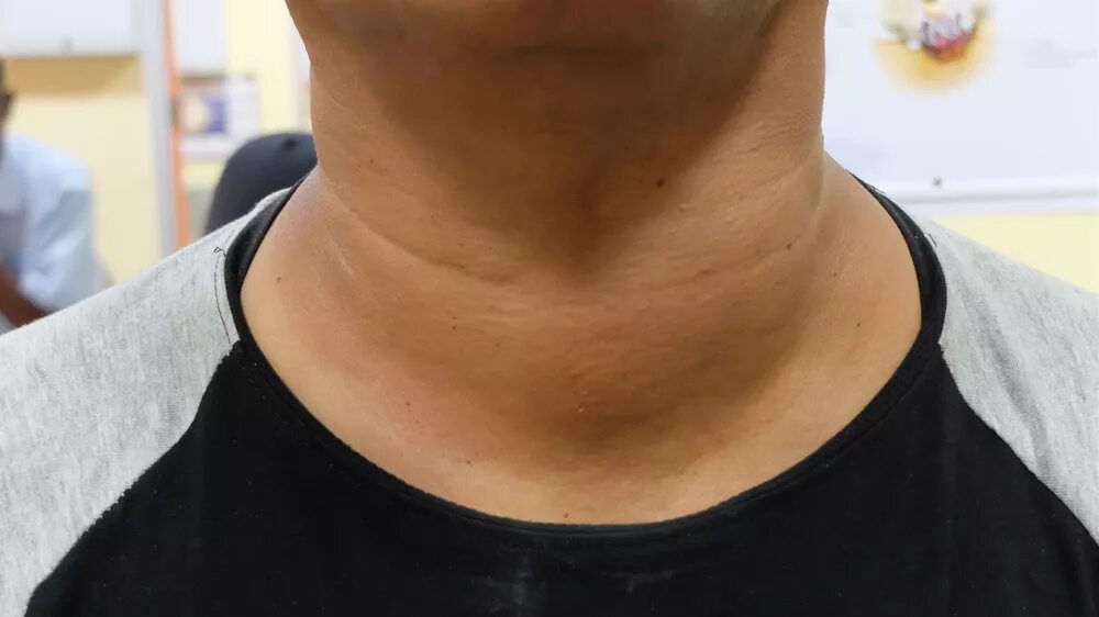 Увеличенная щитовидная железа.