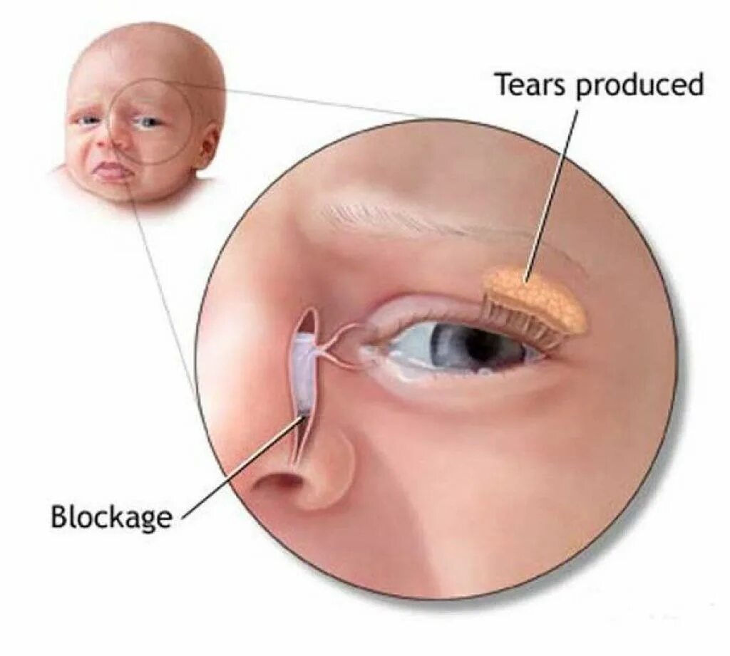 Носослезный канал открывается. Техника массажа слезного канала у грудничка. Непроходимость носослезного канала у грудничка. Дакриоцистит массаж слезного канала. Осложнения хронического Гнойного дакриоцистита.