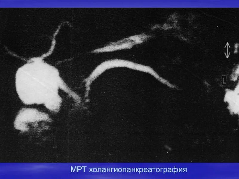 МРХПГ поджелудочной железы. Магнитно резонансная холангиопанкреатография МРХПГ. Холангиопанкреатография мрт. Магнитно-резонансная холангиопанкреато- графия (МР-ХПГ).