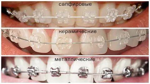 Металлические или керамические