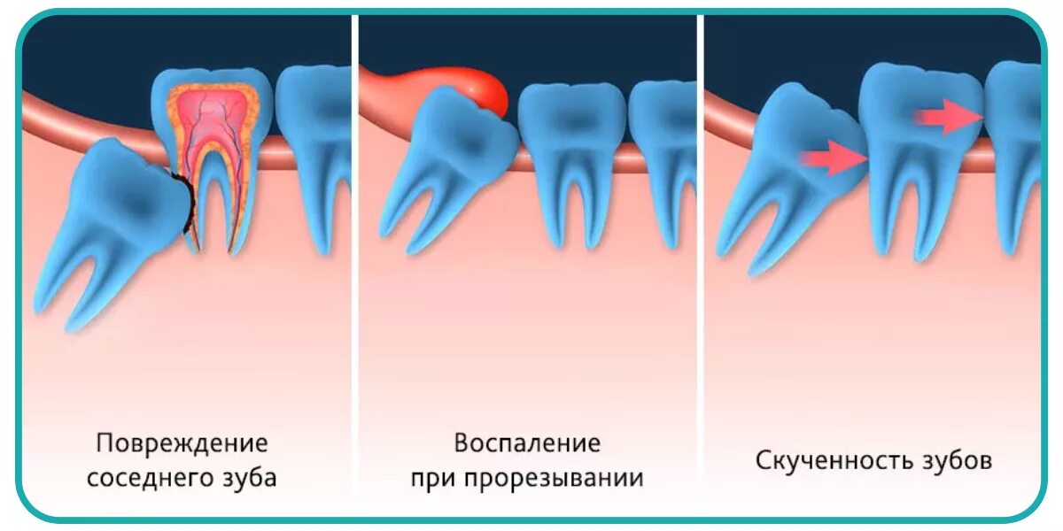 Во сколько вылезают зубы мудрости. Неправильное расположение зуба мудрости. удалённый зуб мудрости.