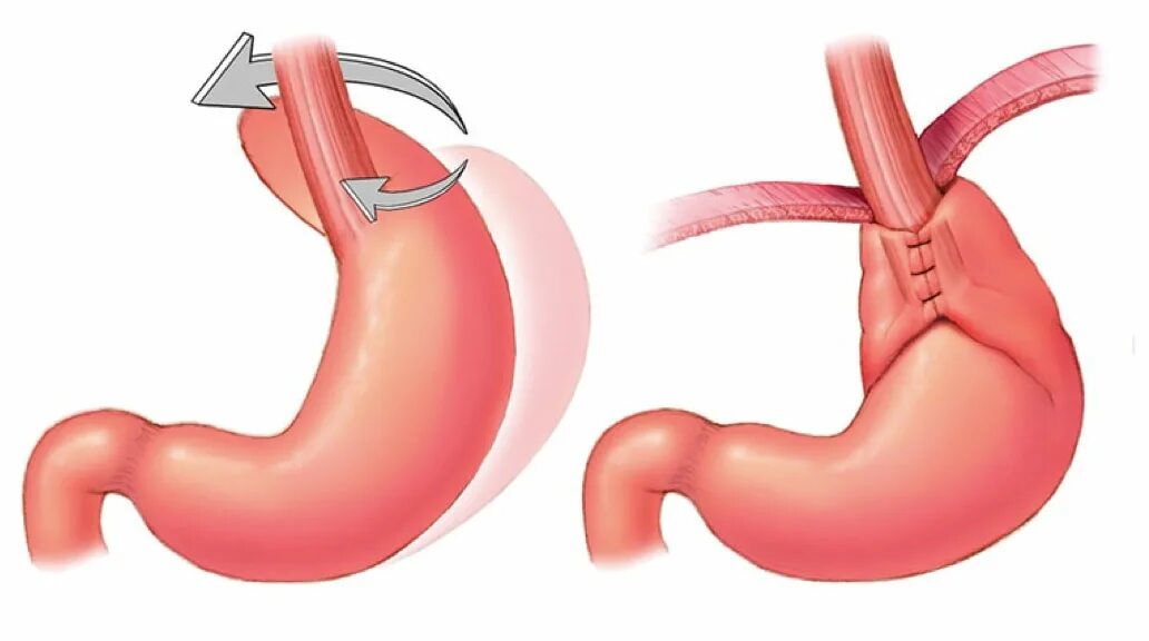 Грыжа пищеводного отверстия диафрагмы. Грыжа пищевода фундопликация. Фундопликация Ниссена. Операция фундопликация по Ниссену.