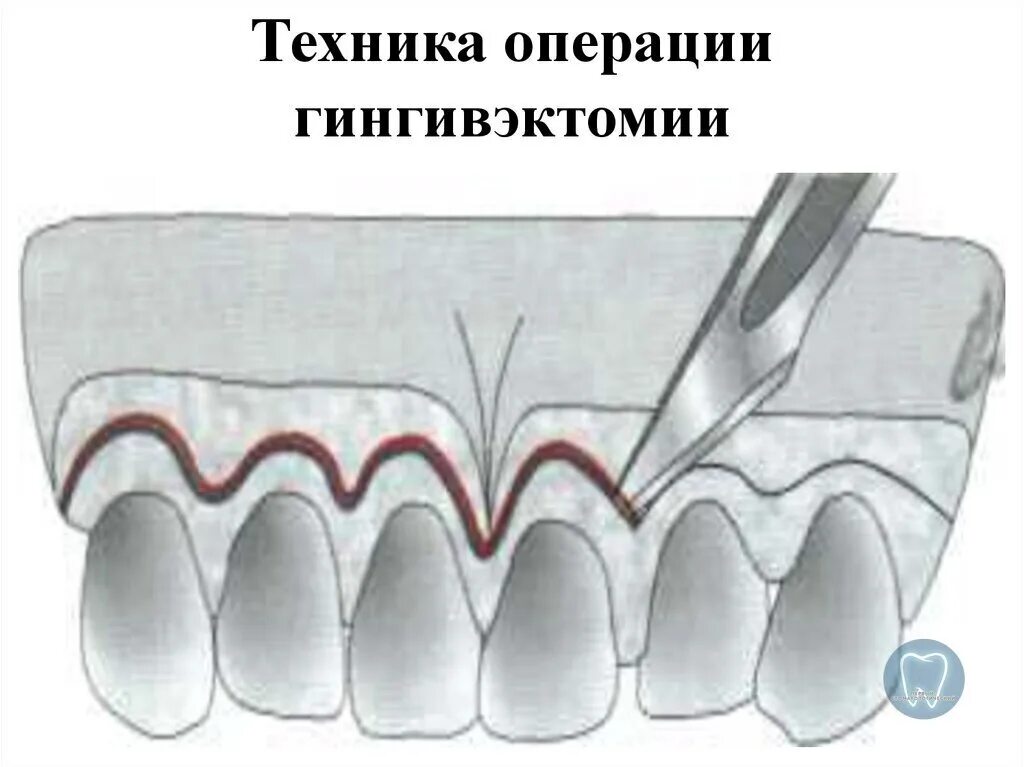 Гингивоэктомия. Гингивоэктомия. Гингивэктомия пародонтит. Лоскутная операция цешинского видмана неймана. Гингивоэктомия.