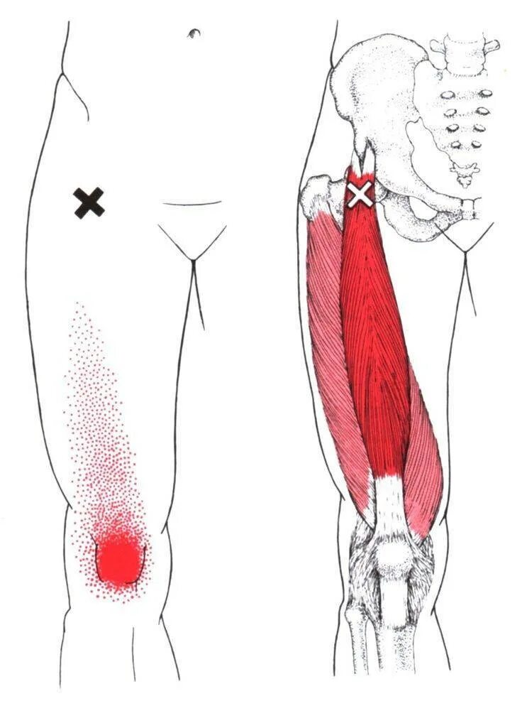 Боль от бедра до стопы. Триггерные точки мышц бедра. Триггерные точки квадрицепс. Триггерные точки прямой мышцы бедра. Триггерные точки бедра триггерные.