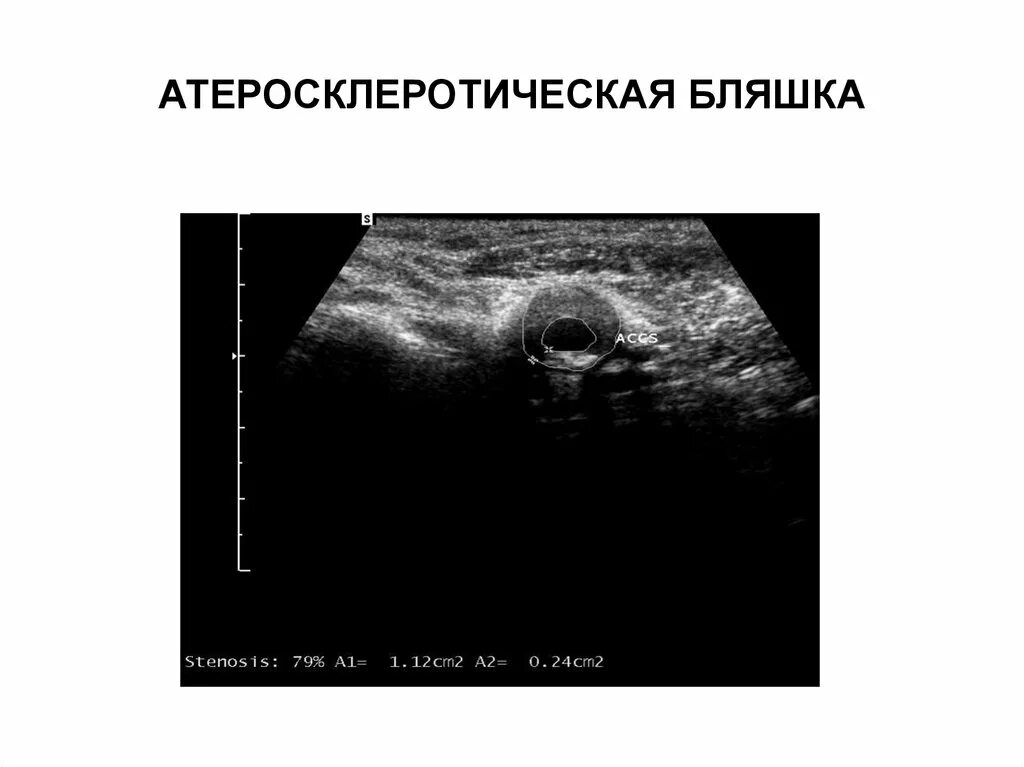 Атеросклеротическая бляшка узи. Тип бляшки узи. концентрическая бляшка. атеросклеротическая бляшка фото.