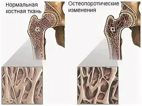 Рак костей признаки как проявляется