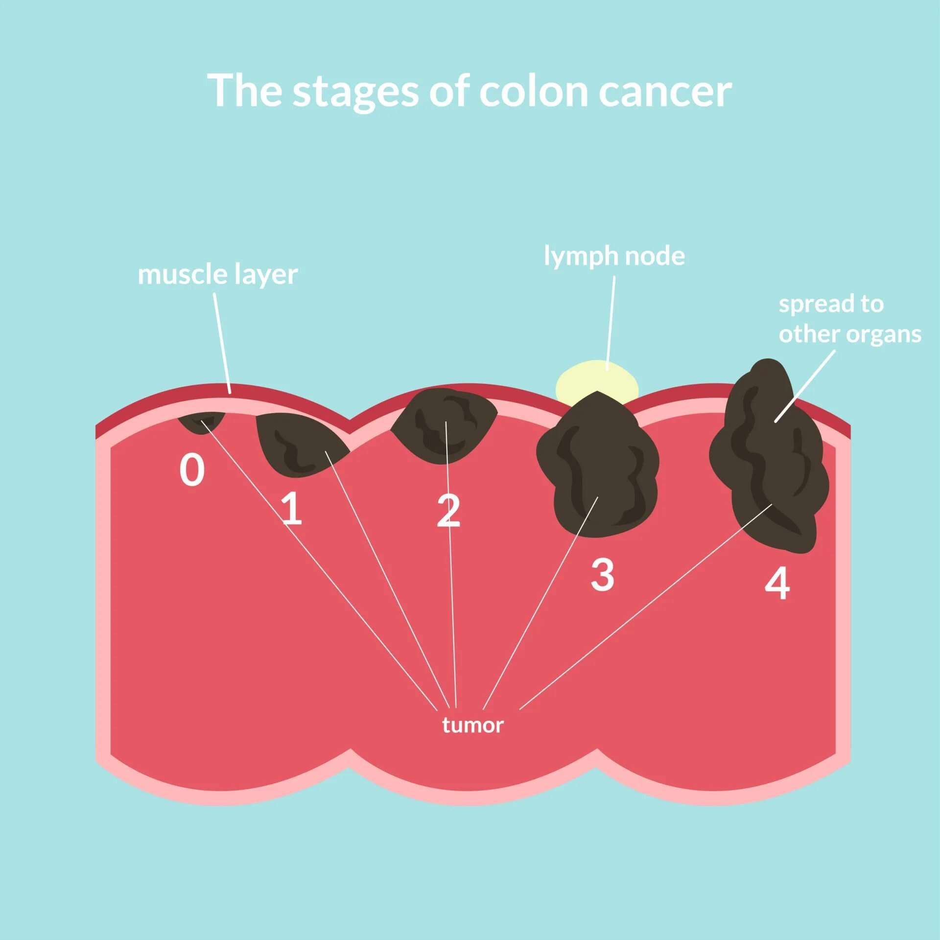 Сщдщкусфед сфтсук ыефпшт. Stages of cancer