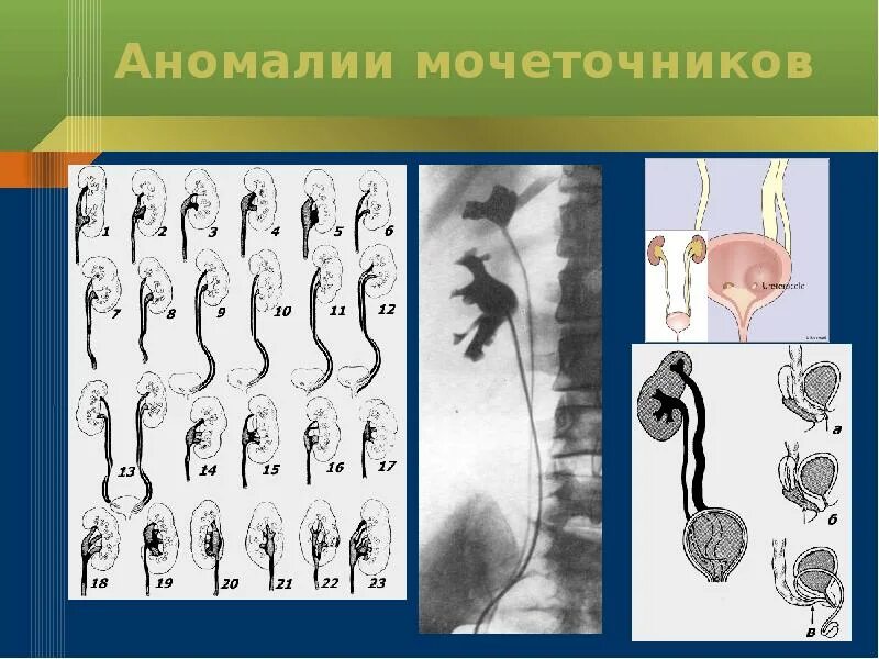 Развитие мочеточников. Пороки развития мочеточника. Аномалии количества мочеточников. Аномалии расположения мочеточников.