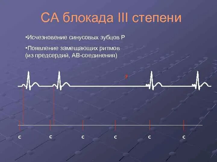 Са блокада 1 степени. Са блокада 2 на ЭКГ. Синоатриальная блокада 2 степени на ЭКГ. Синоатриальная блокада 3 степени на ЭКГ. Са блокада 3 степени на ЭКГ.