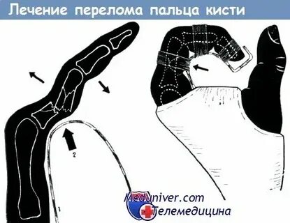 Перелом пальца ноги мкб