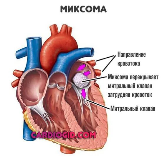 Миксома митрального клапана. Миксома левого. Миксома левого предсердия кт. Миксома левого. Миксома левого.