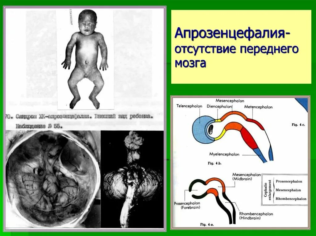 Отсутствие мозга