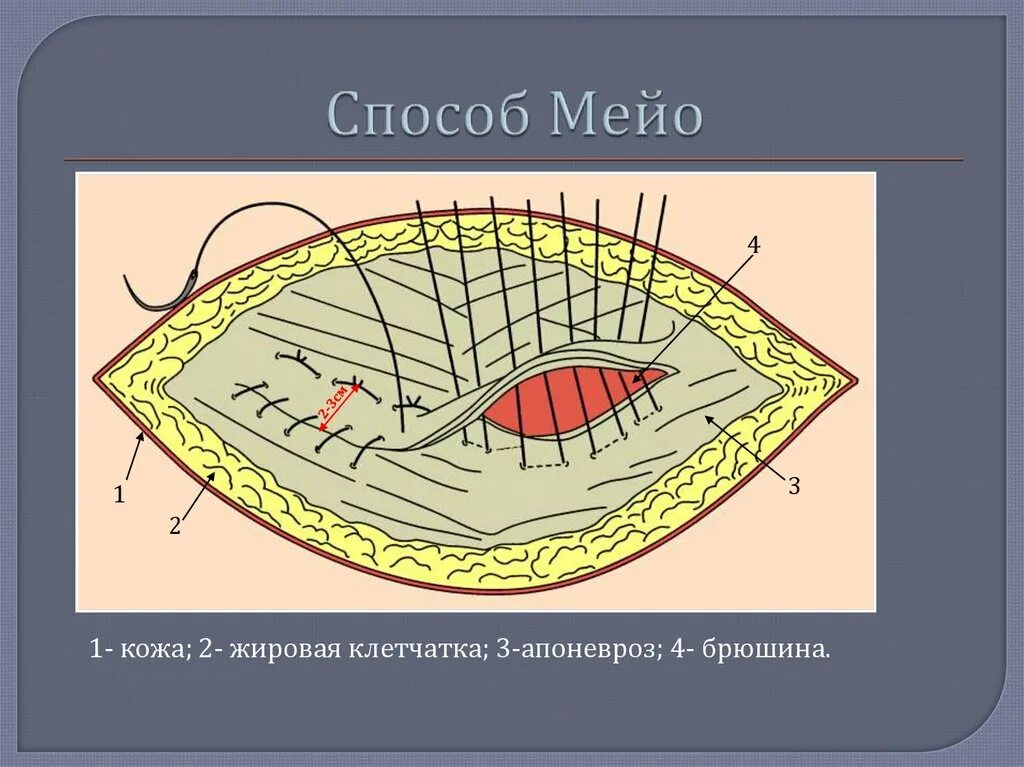 Операция грыжа белой. Пупочная грыжа операция метод мейо.