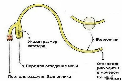 Моча после катетера. Надлобковый мочевой катетер фолея. схема установки мочевого катетера. катетер фолея цистостомический. катетер фолея схема установки.