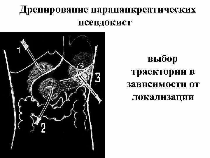 Лимфоузлы ворот печени. Парапанкреатические лимфоузлы. Парапаенаертические лимфоузлы. Дренирование псевдокист. Парапанкреатическая клетчатка.