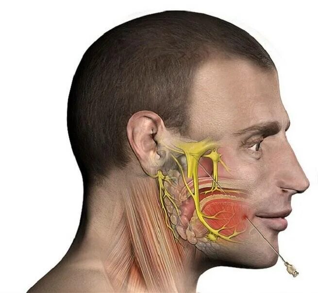 Сильная боль в области уха. Neuralgia тройничный нерв. Ризотомия тройничного нерва. Радиочастотная ризотомия тройничного нерва. Тройничный нерв восполен.