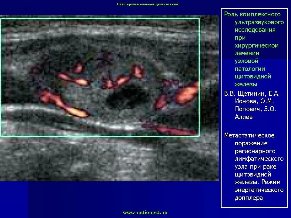 Признаки очаговых изменений щитовидной. Сосуды щитовидной железы на УЗИ. Узловые образования щитовидной железы на УЗИ. Очаговые образования в щитовидной железе. УЗИ картина гиперплазия щитовидной железы.