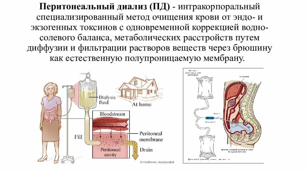 Перитонеальный диализ это