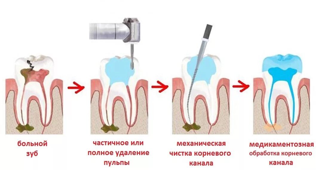 Можно ли греть зубы. Пульпит 2 канального зуба. Корневой канал при воспалении пульпы пломбируют.