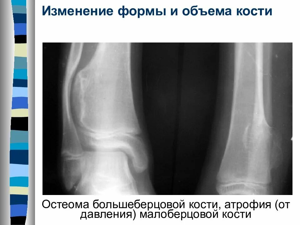 Остеоид большеберцовой кости. Остеоид остеома голени. Остеома берцовой кости рентген. Остеобластома большеберцовой кости кт.