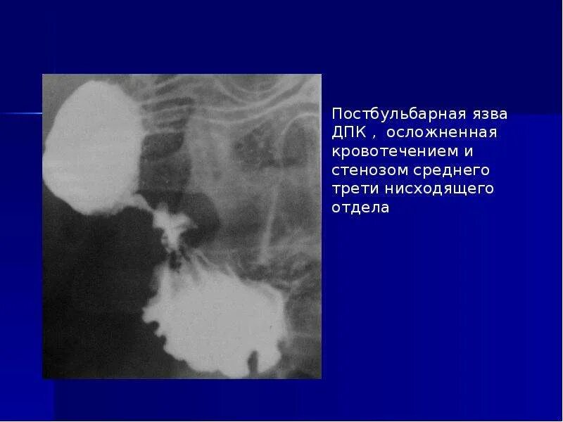Рубцовая деформация луковицы дпк что это