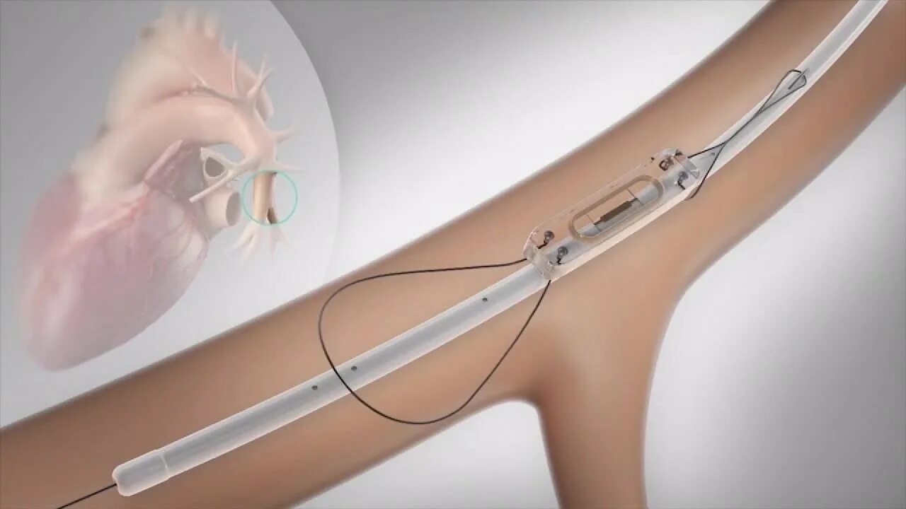 Abbott CARDIOMEMS. Имплантируемые устройства. Имплантируемый венозный порт. Имплантировано приспособление,. Channeling device