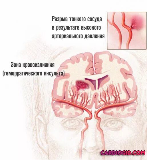 При сужении сосудов давление. При высоком давлении сосуды расширяются или сужаются. Спазм сосудов головного мозга. В бане расширяются или сужаются сосуды головы. При высоком ад сосуды сужаются или расширяются.