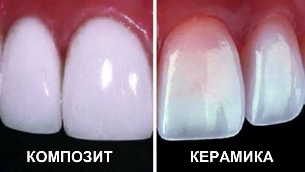 Винир прямой композитный. Композитные виниры componeer. композитные виниры непрямой метод. керамокомпозитные виниры.