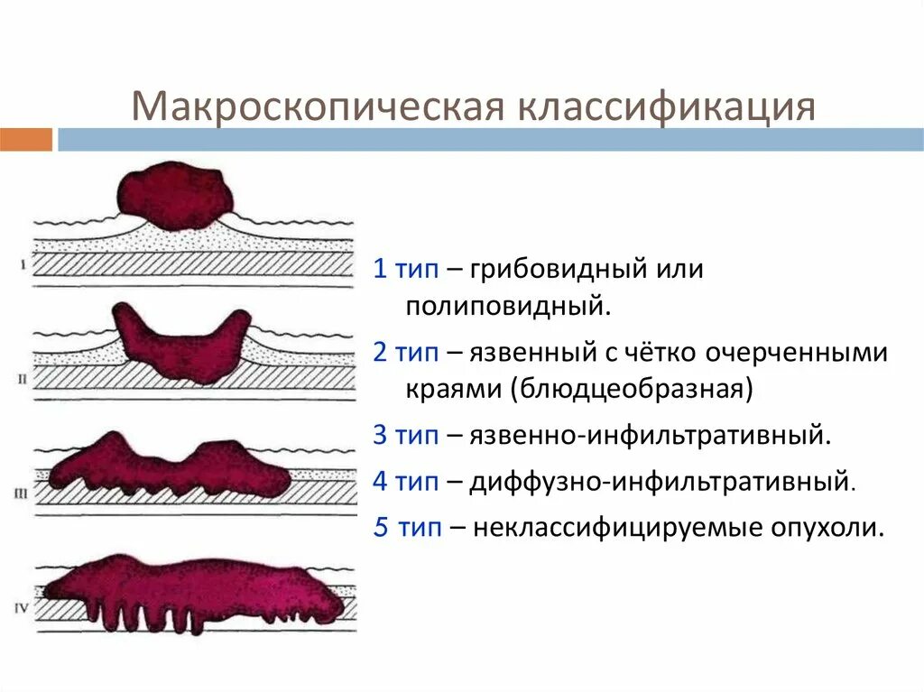 Диффузно инфильтративная. Тип роста опухоли желудка. Opuxol klassifikatsiya. Формы разновидности опухолей виды.