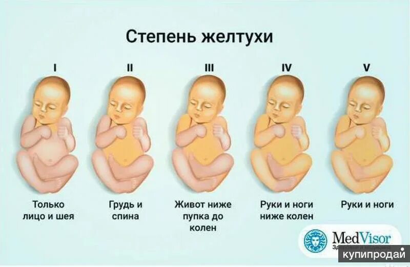 Физиологическая желтуха у новорожденных норма. Желтушка 4 степени у новорожденных. Степени желтухи у новорожденных. Стадии желтухи у новорожденных. Желтуха новорожденных отзывы