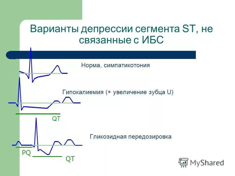 Ишемия передней стенки. Депрессия сегмента St на ЭКГ В 1 отведении. Корытообразная депрессия сегмента St на ЭКГ. Депрессия сегмента St в отведениях v3-v5 до 1 мм. Ишемическая депрессия сегмента St на ЭКГ.