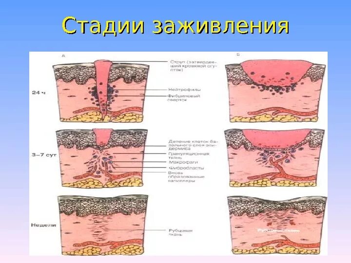 Стадии заживления после. Стадий заживления гнойных РАН. Грануляционная ткань гистология. Заживление РАН. Фазы заживления РАН. Заживление раны вторичным натяжением микропрепарат.