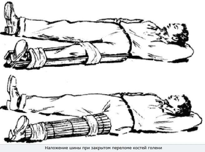 Накладывание шины при переломе голени. Накладывание шины при переломе костей голени. Перелом голени наложение шины. Переноска пострадавшего при переломе голени.