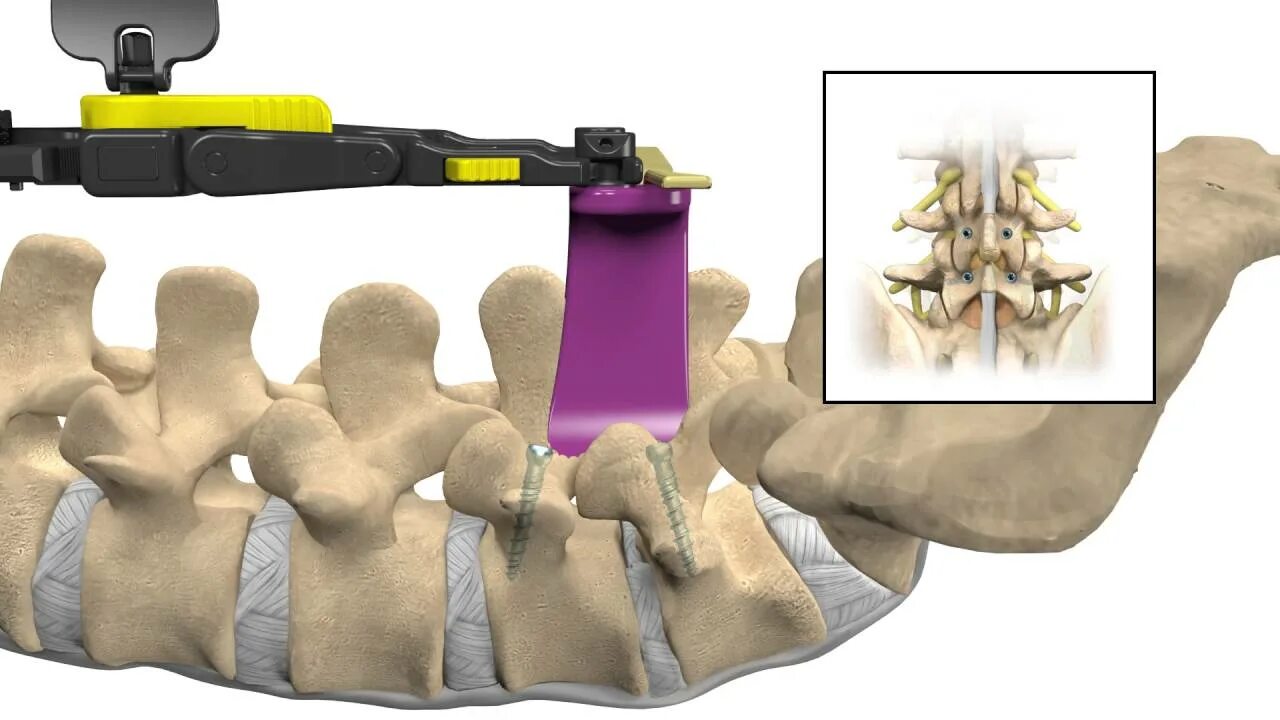 Транспедикулярная фиксация th11-l2. Спондилодез Кейджем ,Medtronic. Спондилолистез транспедикулярная фиксация. Спондилодез поясничного. Операция фиксация позвоночника